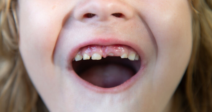 Kid showing new teeth growing. Toothless kids smile. Child losing teeth. Kid with missing tooth close-up mouth. Dental growth in child.