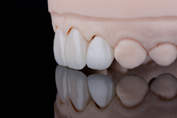 Four dental ultra-thin ceramic veneers in bleach color for fixation to frontal teeth of upper jaw. © gorynvd