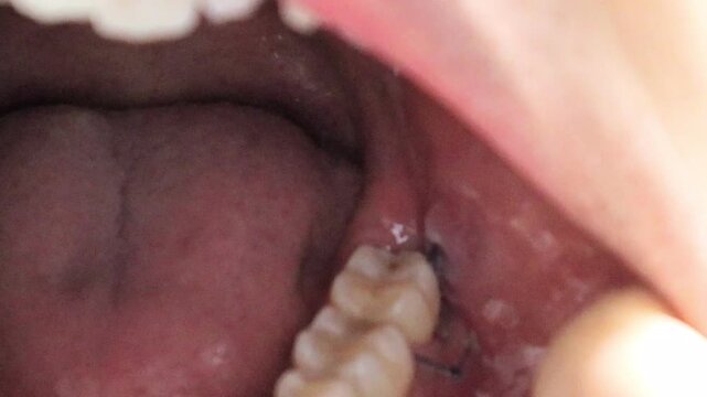 親知らずの抜歯で縫合された口の中の動画