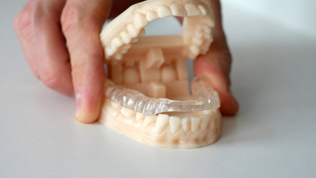Close-up of a 3d dental mold with a splint on the lower teeth row in a male hand