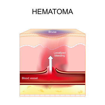 Hematoma. Bruise and Localized bleeding in skin. Blood vessel after vascular injury.