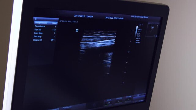 Color Doppler Ultrasound Scan of Lower Extremity Artery on Monitor