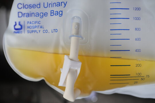 Taipei, Taiwan - December 27th 2025 - Closed urinary drainage bag with yellow fluid.
