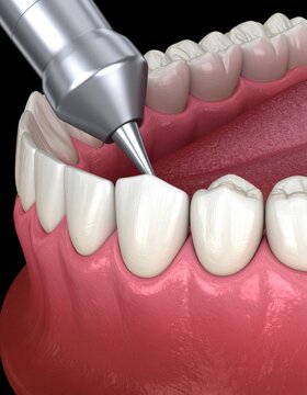 Dental crown premolar tooth assembly process. Medically accurate 3D illustration of human teeth treatment