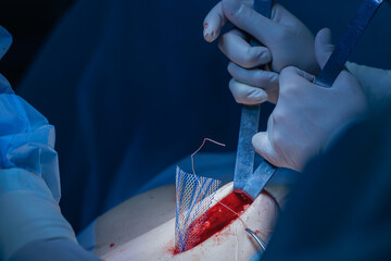 Surgical procedure with mesh implant in operating room after abdominal surgery