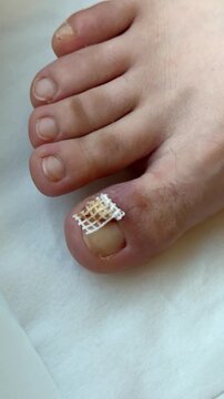 Closeup Bleeding Toenail With Mesh Dressing, Clinic FollowUp After Partial Nail Avulsion Showing Gauze And Adhesive, Scab And Crust Formation, Careful Wound Care In Sterile Setting, Patient