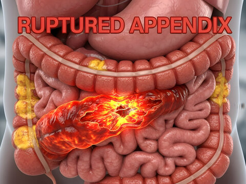 Ruptured appendix causing severe abdominal pain and inflammation
