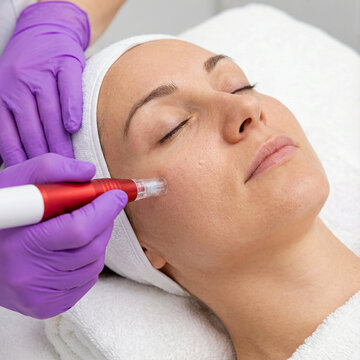 Woman receiving professional microneedling skin treatment with mesotherapypen at a beauty clinic