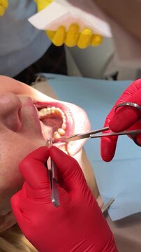 Removing stitches in dentistry after tooth extraction Oral surgeon, nurse doing medical operation on root canals in operating room.. Dental surgery, installation of dental implants.