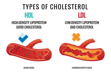 Types of cholesterol in human blood vessels. Normal and narrowed artery for explanation diseases. High-Density Lipoprotein HDL and Low-Density Lipoprotein LDL. Vector illustration