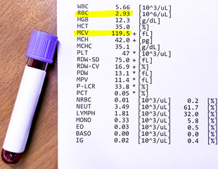 Hematological report: Low RBC and High MCV, Suggestive of Pernicious anemia or Alcoholic liver disease or Bone marrow disease.