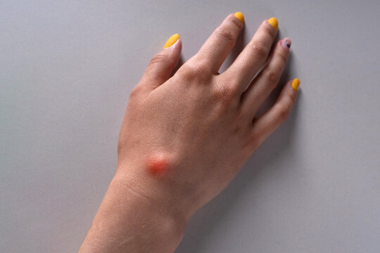Ganglion cyst on woman hand on white background