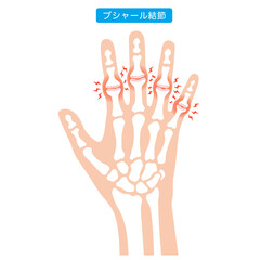 ブシャール結節　指の関節の病気