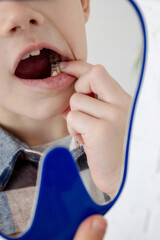 Child pointing at a decayed tooth in the mirror, close-up of dental cavity issues