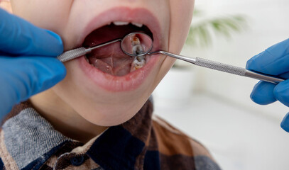 A dentist examines a child's tooth cavities using a mirror and probe. Tooth decay