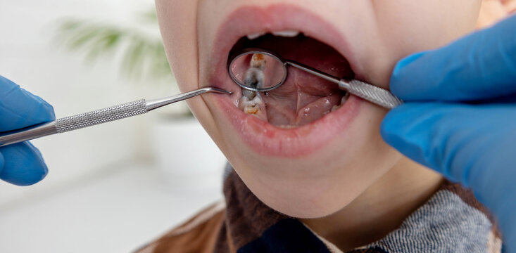 A dentist examines a child's tooth cavities using a mirror and probe. Tooth decay