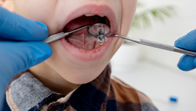 A dentist examines a child's tooth cavities using a mirror and probe. Tooth decay