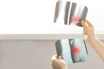 A doctor holds and examines X-rays of a fractured arm on a light screen. Medical diagnosis of injury, bone monitoring