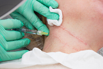 Smoothing female neck skin with injections in neck at cosmetic clinic. Neck skin rejuvenation and contouring, mesotherapy and biorevitalization