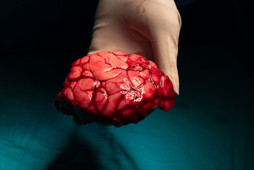 Abnormal Brain cortex causing epilepsy in Surgeon&rsquo;s Gloved Hand