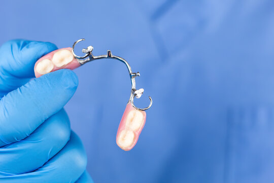 Dentist's hand showing a removable cobalt-chromium partial denture. Oral rehabilitation, advanced dentistry, and dental health in a dental clinic. Tooth replacement and stomatology.