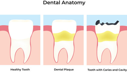 Dental Anatomy Healthy Tooth Plaque and Cavity Progression