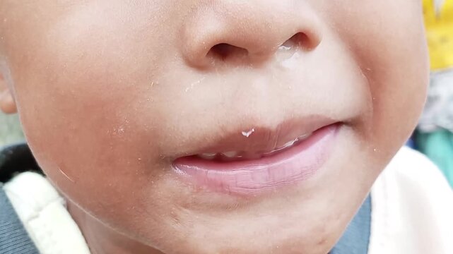 Maintaining children's health. Early childhood caries (ECC), or baby bottle tooth decay, is often caused by prolonged exposure to sugar from bottle-feeding, sugary drinks, or poor oral hygiene.
