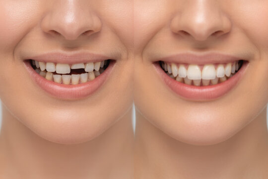 Collage of woman with diastema between upper front teeth before after treatment,showing big gap crack,older middle aged female needs stomatology dentist,medicine healthcare close up. 