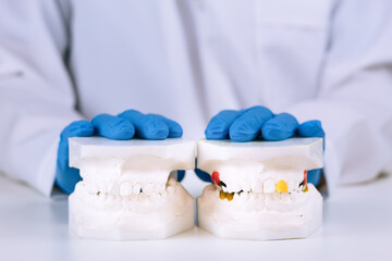 Clinical record using a plaster model for dental study. Facilitates preventive diagnosis and planning of long-term treatments in orthodontics and dental prosthetics. © Tom