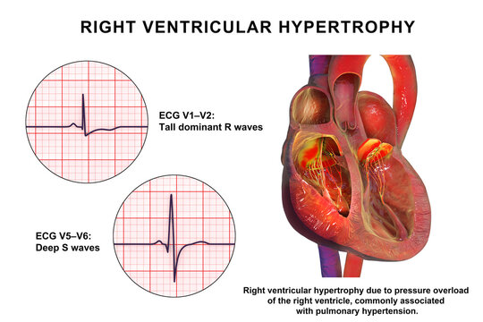 Right ventricular hypertrophy, 3D illustration showing thickened right ventricular myocardium with ECG examples in leads V1-V2 and V5-V6 demonstrating characteristic voltage changes.
