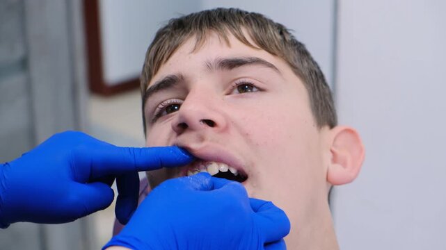 Dentist hands in gloves inserting butterfly type micro denture into upper jaw of teenage boy. Partial prosthetics of one tooth. Temporary single removable butterfly dental prosthesis