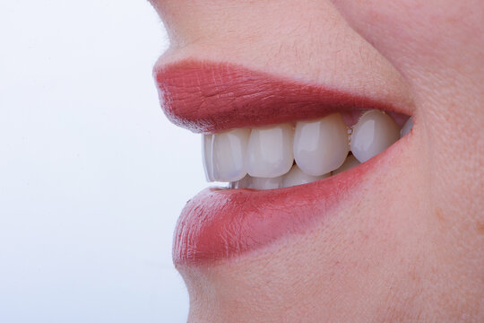 Female smile makeover by dental ceramic veneer, porcelain laminate veneers. Side view