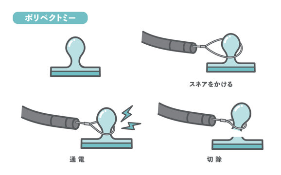 大腸ポリープ切除（ポリペクトミー）の手順・図解イラスト