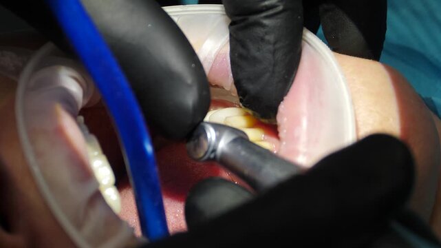 Dentist prepares female teeth and removes tooth enamel for installation of ceramic veneers and crowns using drill. Artificial teeth. Ceramic dentures and crowns. Zirconium crown. Dental and teeth care