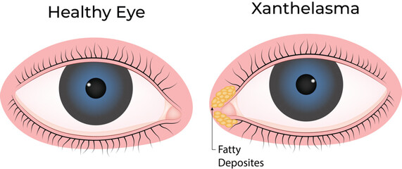 Xanthelasma Healthy Eye vs. Fatty Deposits Comparison