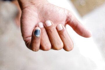 Injured Finger with Dried Blood from Pinched Accident