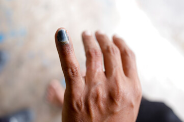 Injured Finger with Dried Blood from Pinched Accident