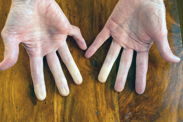 Close-up of two adult hands with Raynaud's syndrome