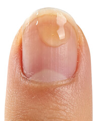 Fototapeta premium Close-up of Drop of Serum on Fingernail for Beauty and Health