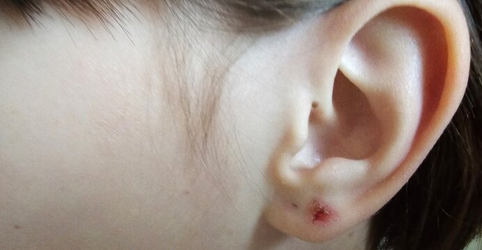 Symptoms ear damage by herpes zoster. inflammation on the earlobe and ear inflammation after puncture pus wound concept