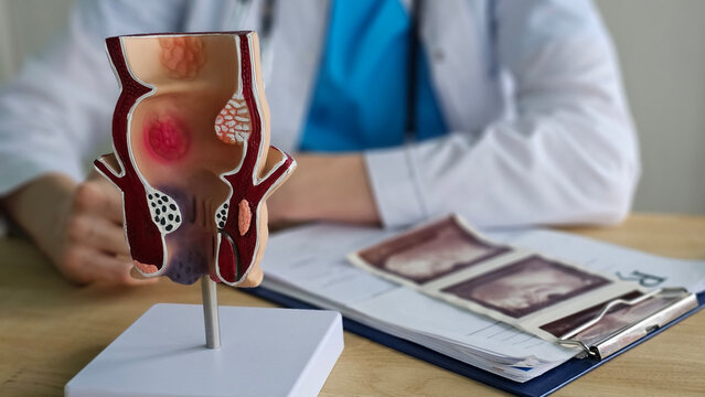 Doctor with model of human rectal anatomy and hemorrhoids in hospital