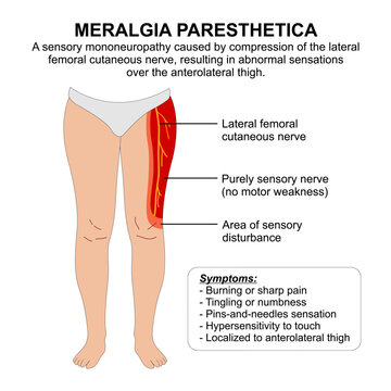 Meralgia Paresthetica infographic flashcard illustration