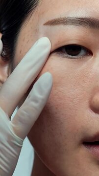 Female Endolift for Malar Bag Reduction. Eye bags, aesthetics, women.