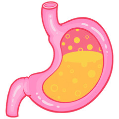 Stomach illustration showing acid reflux in gastroesophageal reflux disease (GERD)