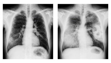 Medical chest Xray comparison with clear unmarked lung image next to a similar Xray featuring labeled suspicious shadow areas emphasizing diagnostic variations in lung health.