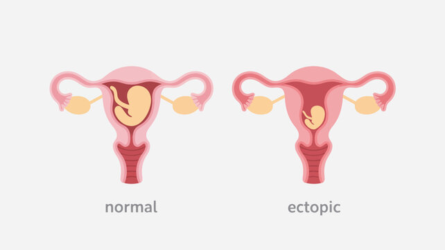 Informative medical diagram showing a healthy pregnancy in the uterus versus an ectopic gestation in the fallopian tube