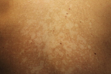 Fototapeta premium Tinea Versicolor on the Back with Hypopigmented Skin Patche