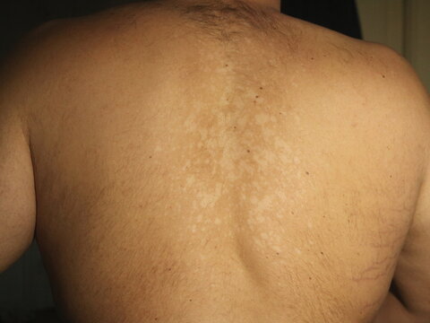 Tinea Versicolor on the Back with Hypopigmented Skin Patche
