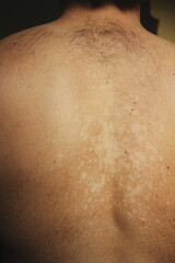 Fototapeta premium Tinea Versicolor on the Back with Hypopigmented Skin Patche