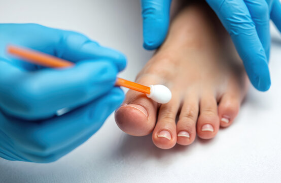 Doctor applies medicine to toe for corn treatment. Healthcare professional uses applicator for skin therapy on foot. Patient receives medical care for foot problem. Toe nail care.